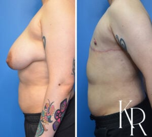 Before and after top surgery