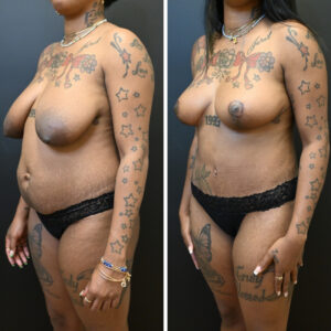 A side-by-side comparison of a person with tattoos before and after breast augmentation. The individual is wearing black underwear and various jewelry. The left image shows the original state, while the right shows the enhanced appearance.