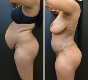 Side by side comparison of before and after a tummy tuck procedure.